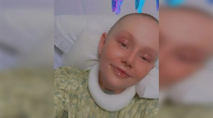 Ženi otpala koža nakon reakcije na lijek koji mnogi koriste: Ima 5 posto šansi za preživljavanje - featured image