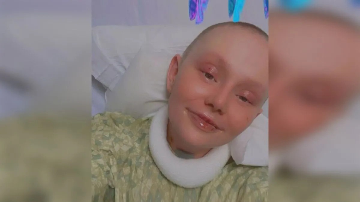 Ženi otpala koža nakon reakcije na lijek koji mnogi koriste: Ima 5 posto šansi za preživljavanje - featured image